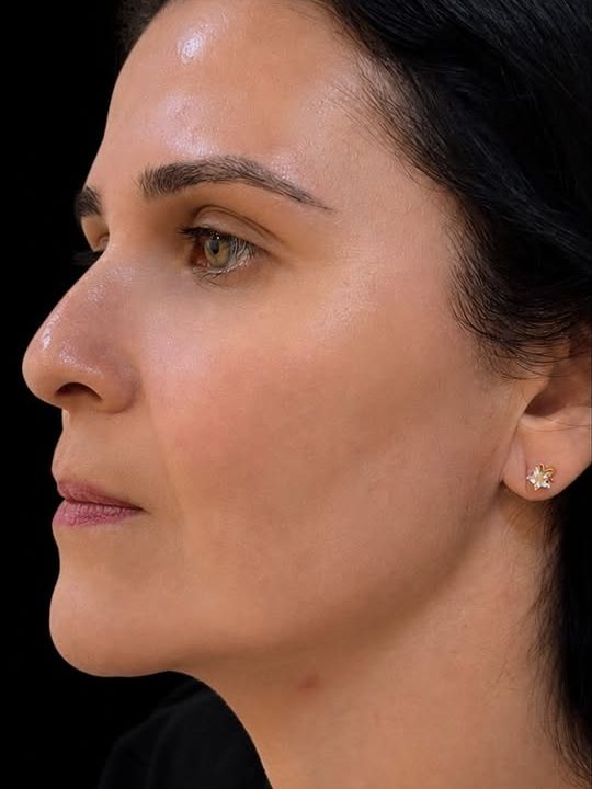 Antes da harmonização facial