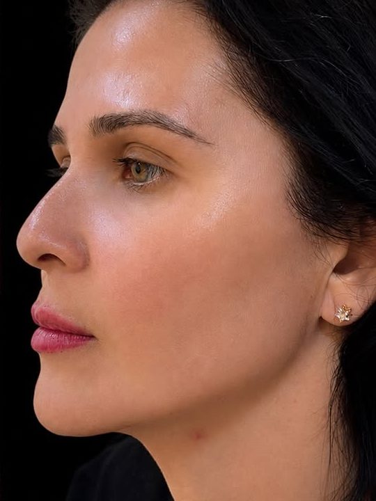 Depois da harmonização facial